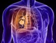 Does Lung Cancer Have A Cure