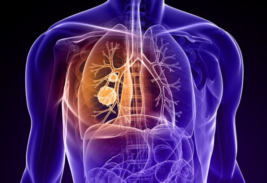 Does Lung Cancer Have A Cure
