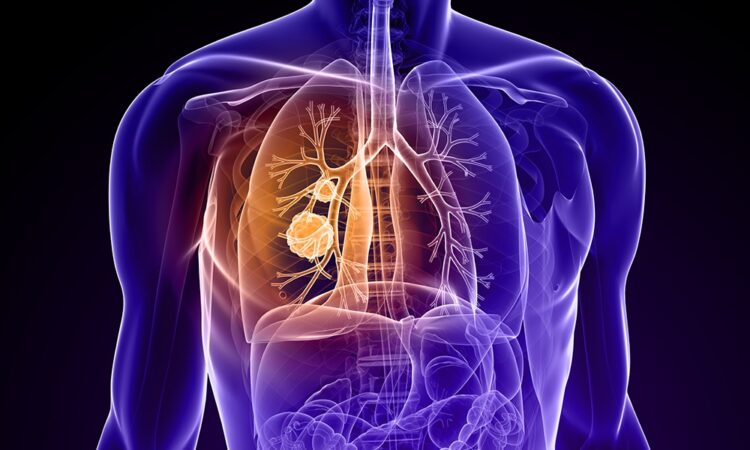 Does Lung Cancer Have A Cure