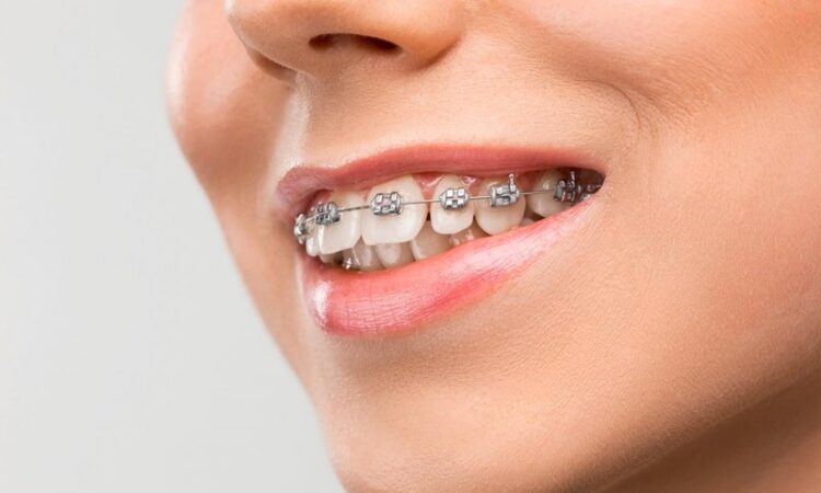 orthodontist st louis