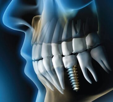 Dental Implants in Dubai
