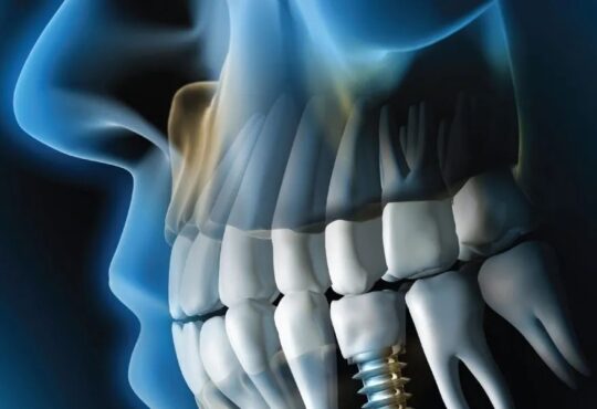 Dental Implants in Dubai